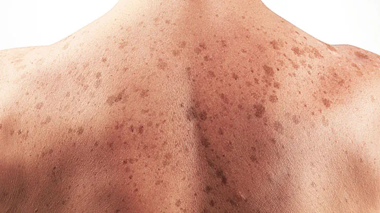 هایپرپیگمانتاسیون