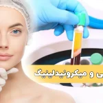 پی آر پی و میکرونیدلینگ