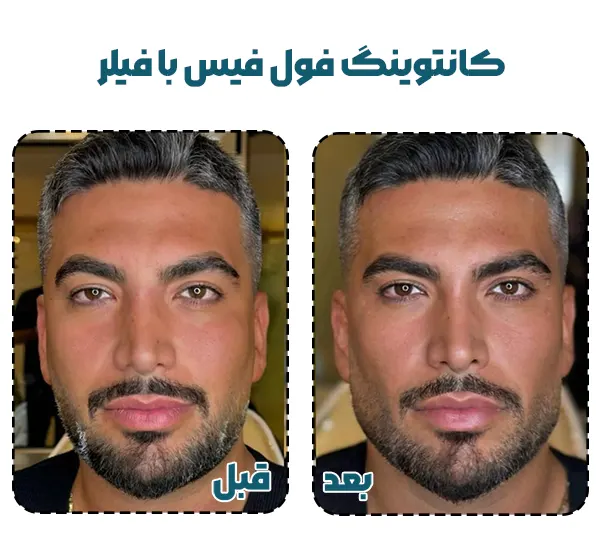 کانتورینگ فول فیس صورت با فیلر