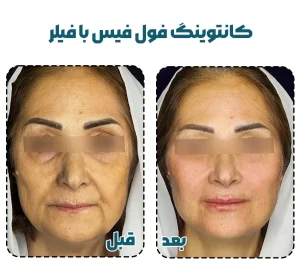 کانتورینگ صورت با فیلر