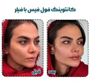 کانتورینگ صورت با فیلر