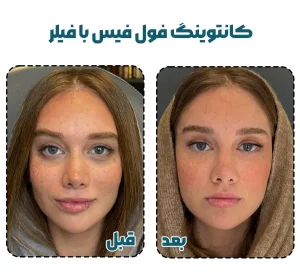 کانتورینگ صورت با فیلر