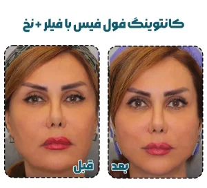 کانتورینگ صورت با نخ و فیلر